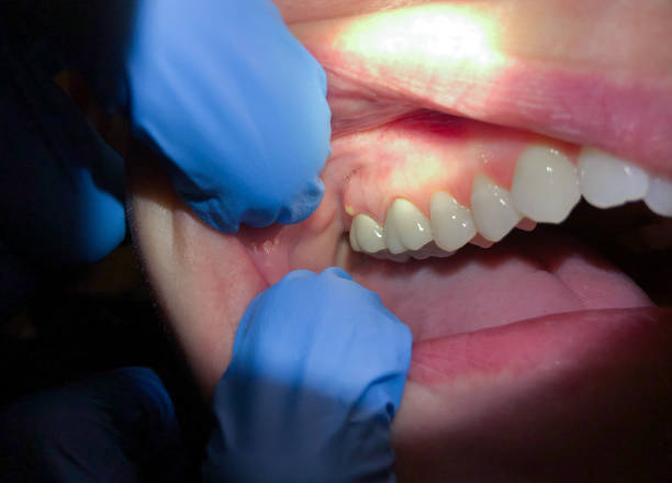 Best Emergency Dental Care for Broken or Chipped Teeth in Hughesville, PA